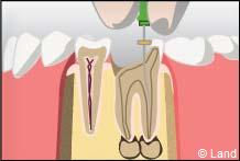 traitement radiculaire