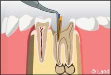 traitement radiculaire