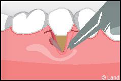 Chirurgie mucogingivale