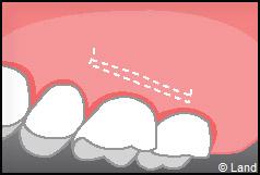 Chirurgie mucogingivale
